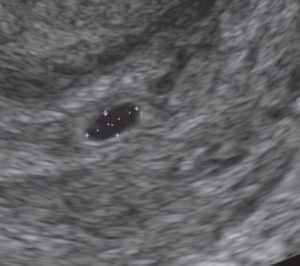 Week 5 Ultrasound Image